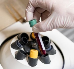 Herstellung von plättchenreichem Plasma in einer Zentrifuge